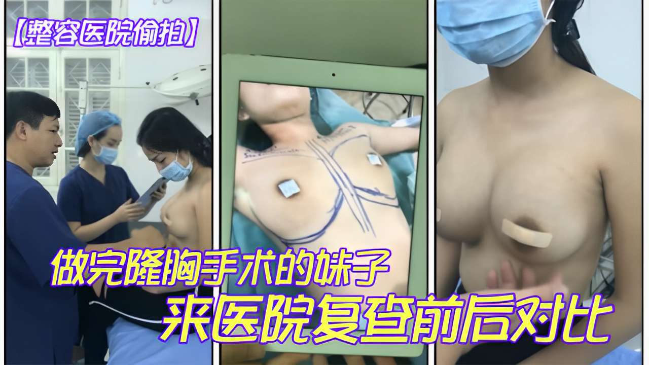 整容医院偷拍做完隆胸手术的咪子来医院复查前后对比